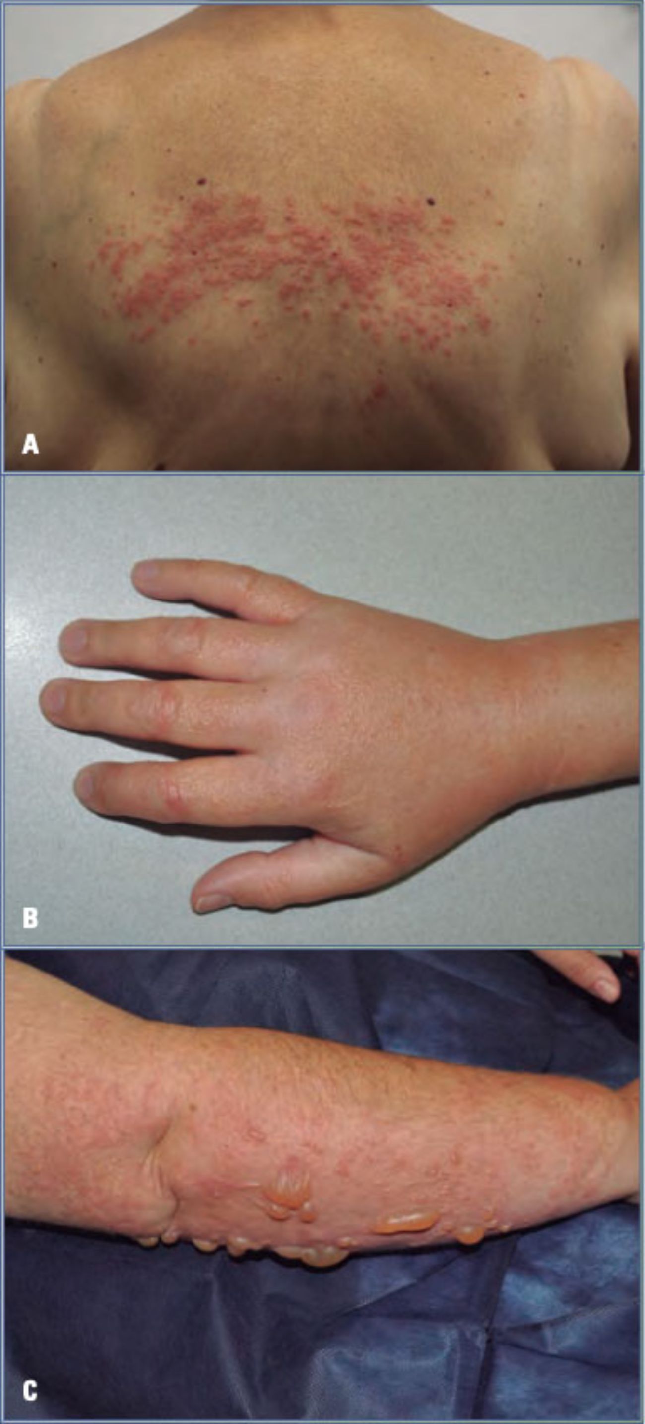 caracteristicas-eczema-dermatitis-atopica