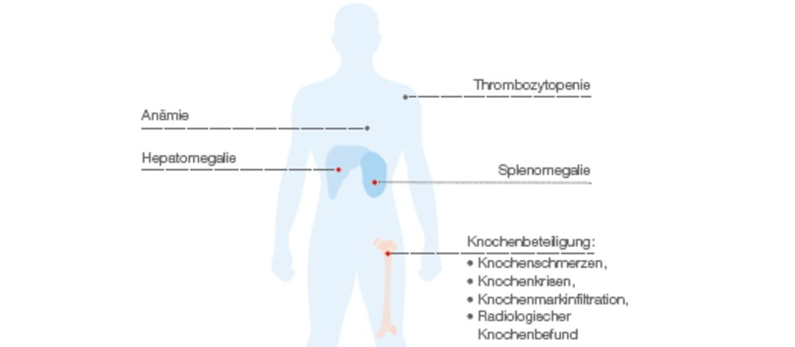 Zeichnung eines Menschen auf dem die wichtigsten Symptome hervorgehoben sind
