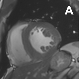 Bild einer medizinischen Bildgebung (MRI) des Herzens.