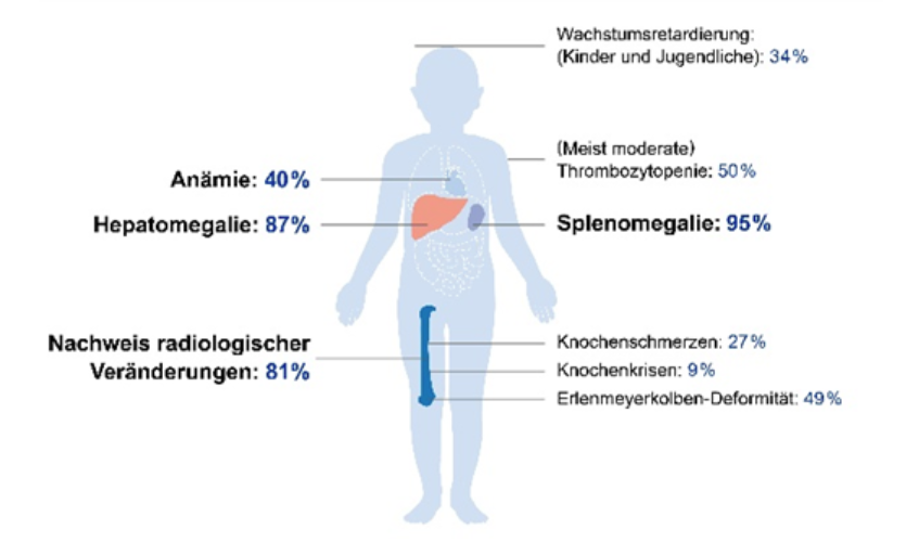 Silhouette eines Kindes mit farblich hervorgehobener Leber und Milz, daneben medizinische Prozentangaben zu Anämie, Hepatomegalie, Splenomegalie und weiteren Symptomen.