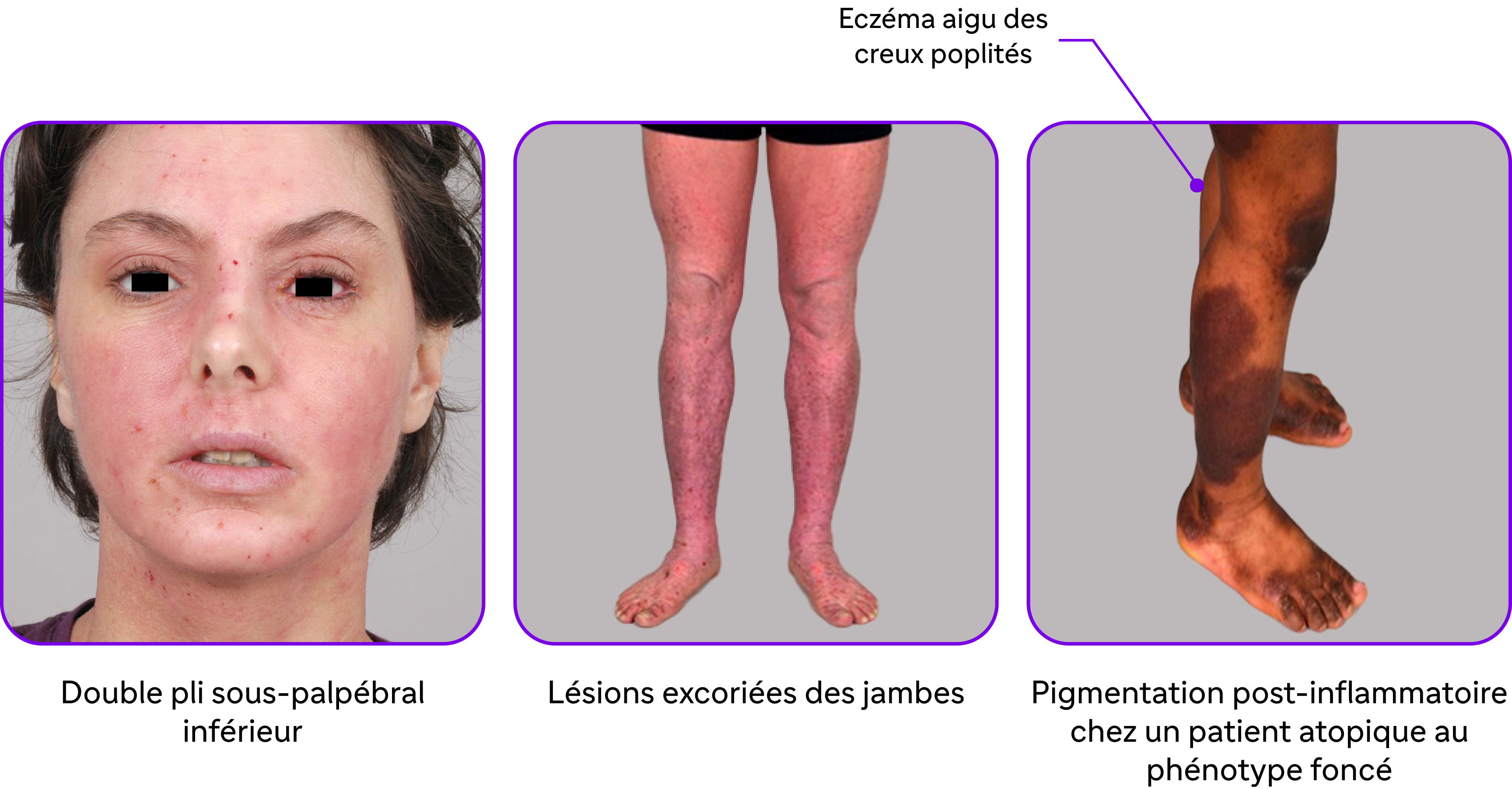 Localisations de la dermatite atopique sur l'ensemble du corps