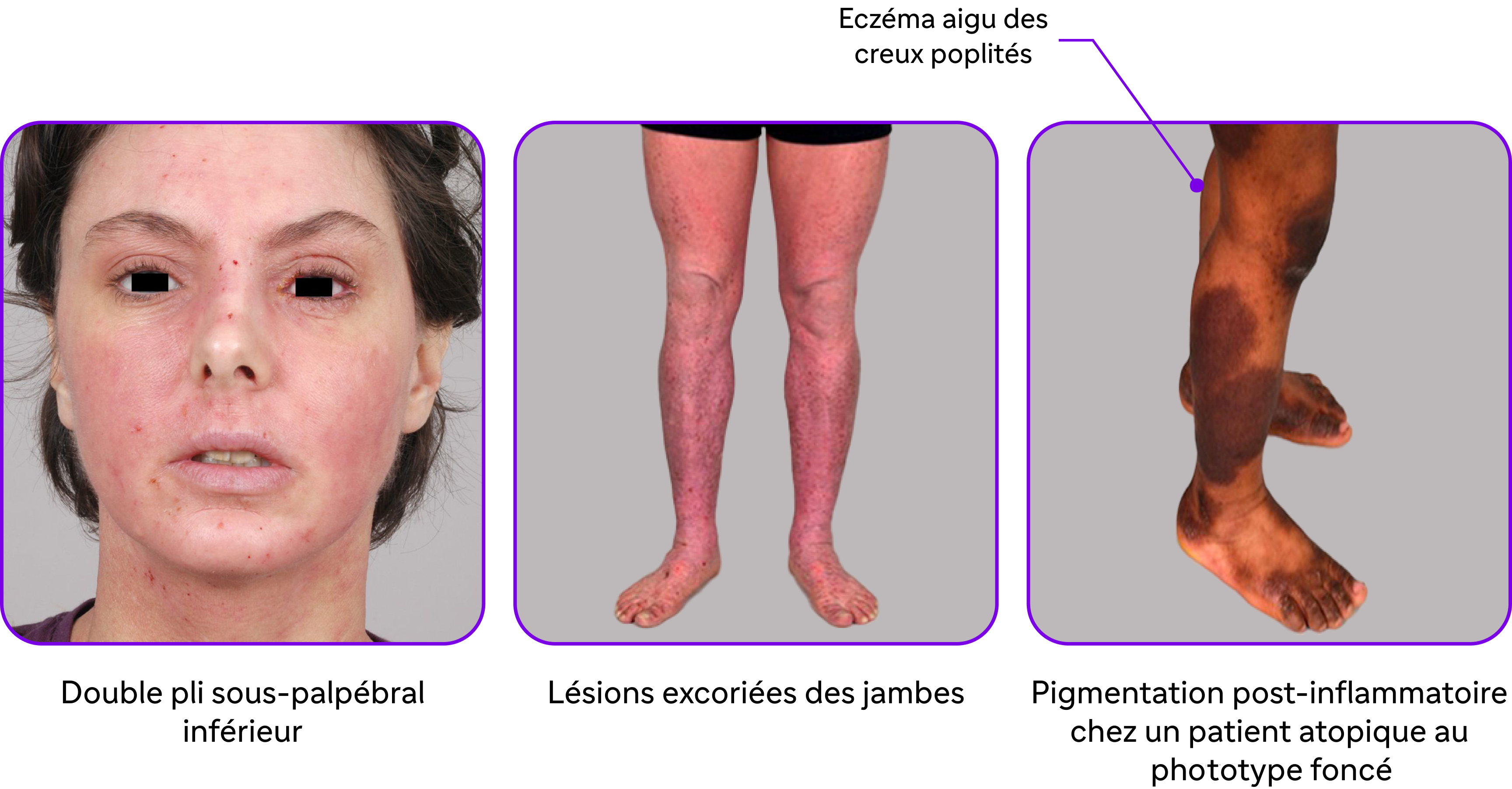 Localisations de la dermatite atopique sur l'ensemble du corps