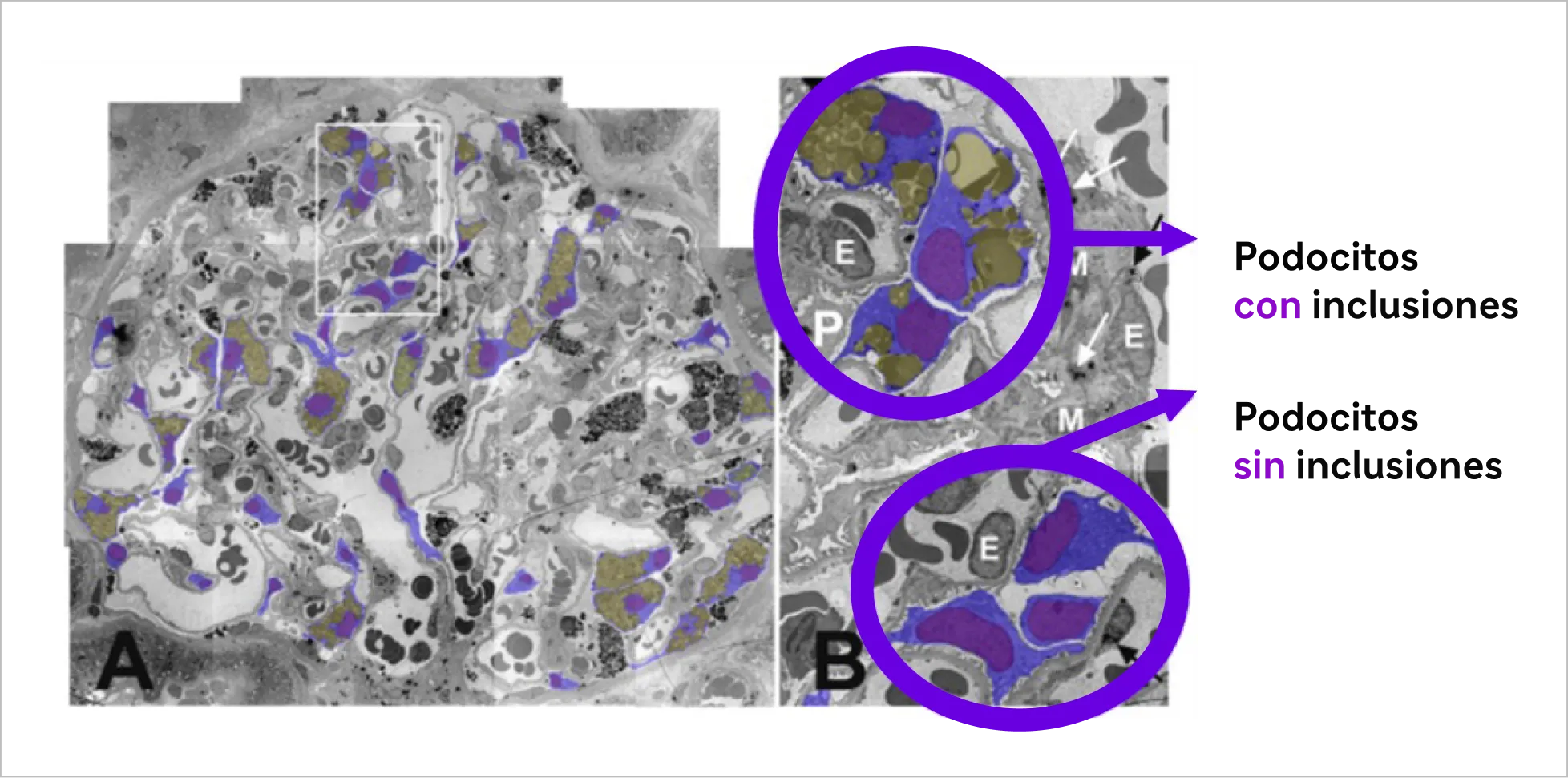 Microscopía electrónica del glomérulo en una mujer con enfermedad de Fabry, mostrando mosaicismo en podocitos con y sin inclusiones de Gb3