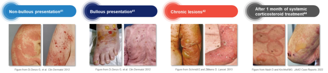 A panel of clinical images showing non-bullous and bullous presentations, chronic lesions, and skin appearance after one month of systemic corticosteroid treatment in bullous pemphigoid.