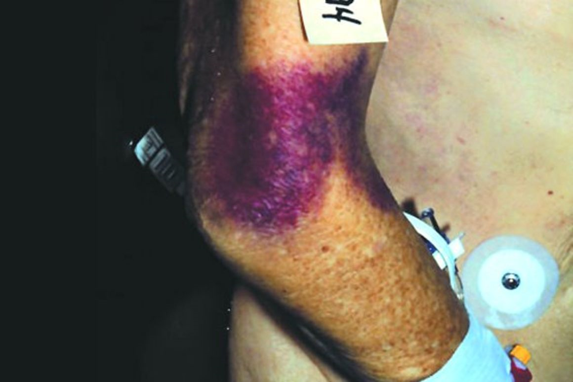 Oberarm mit großflächiger, dunkelvioletter Bluterguss am Ellenbogen zeigt eines der hämatologischen Symptome bei Morbus Gaucher: Erhöhte Hämatomneigung als Folge der Thrombopenie