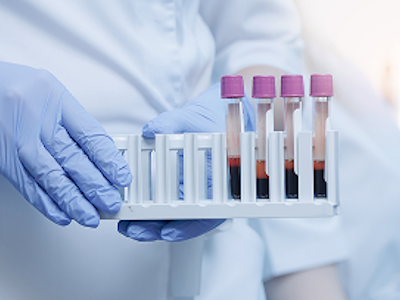 Stadien beim Multiplen Myelom
