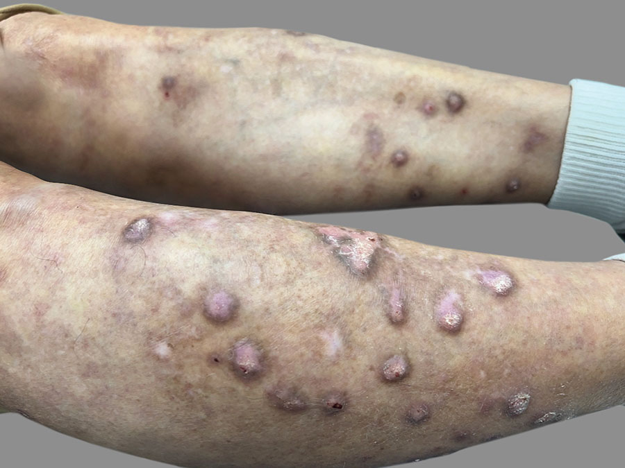 legs-nodules