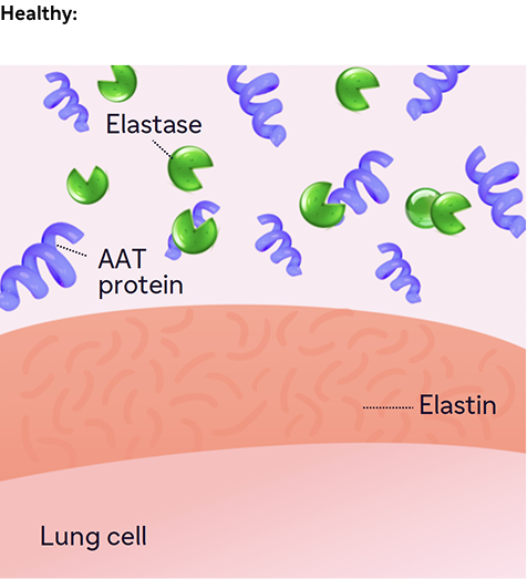 Illustration of healthy AAT protein and elastase balance