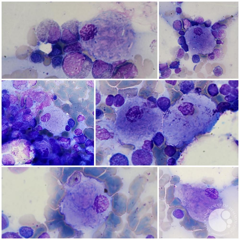 Gaucher cells