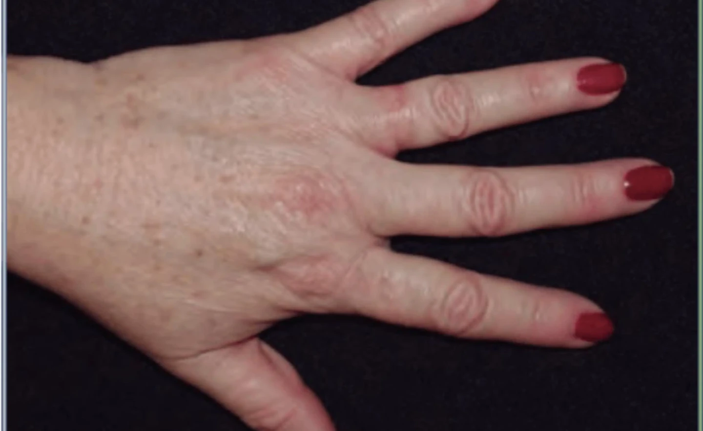 eczema de contacto