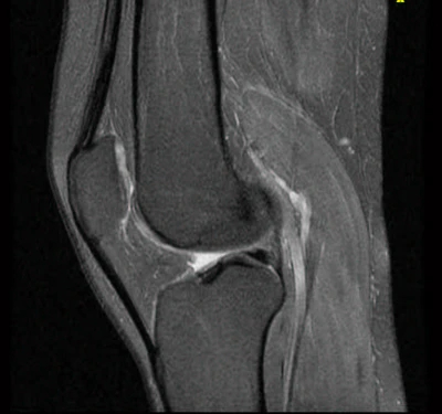 atrosis-de-rodilla