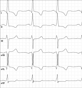 Schwarz-weißes EKG mit sechs Ableitungen V1 bis V6, zeigt regelmäßige Herzschläge mit charakteristischen Zacken.