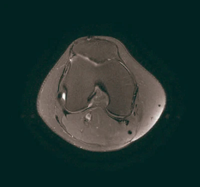 atrosis-de-rodilla