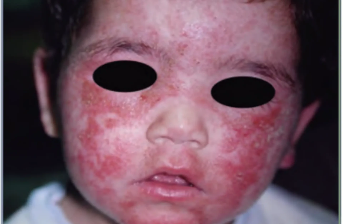 imagen dermatitis atopica lactante