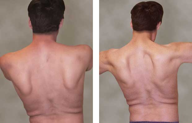 Rückenasicht eines Patienten mit Muskelschwäche am Rücken und Scapula alata bei Morbus Pompe