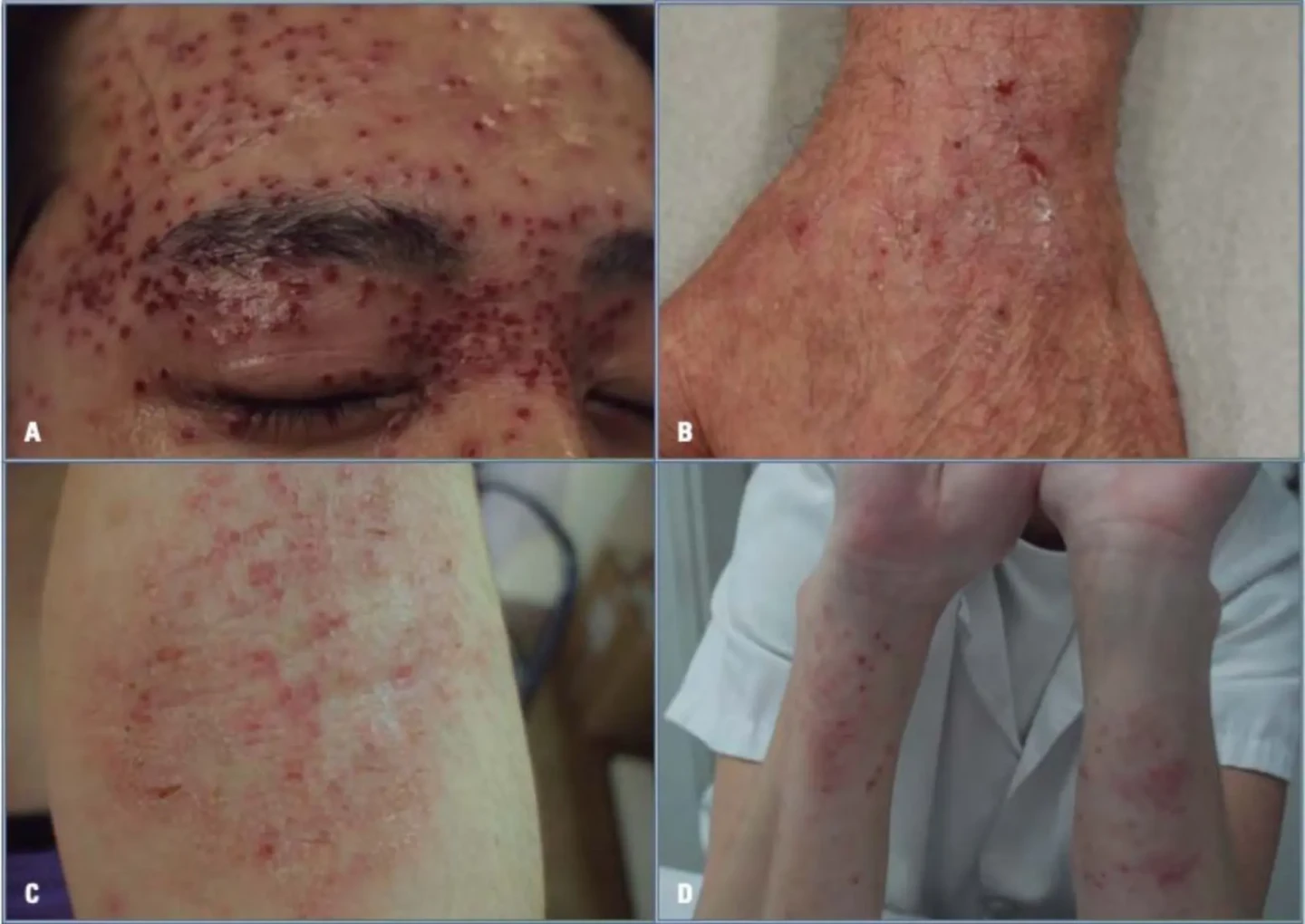 imagen eczema crónico