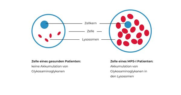 Zwei schematische Zellgrafiken: links eine gesunde Zelle mit Zellkern und wenigen Lysosomen, rechts eine MPS-I-Zelle mit Zellkern und vielen Lysosomen, die Glykosaminoglykane akkumulieren.