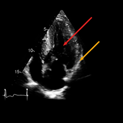 Ultraschallbild mit zwei Pfeilen bei der Speckle-Tracking-Analyse bei Morbus Fabry