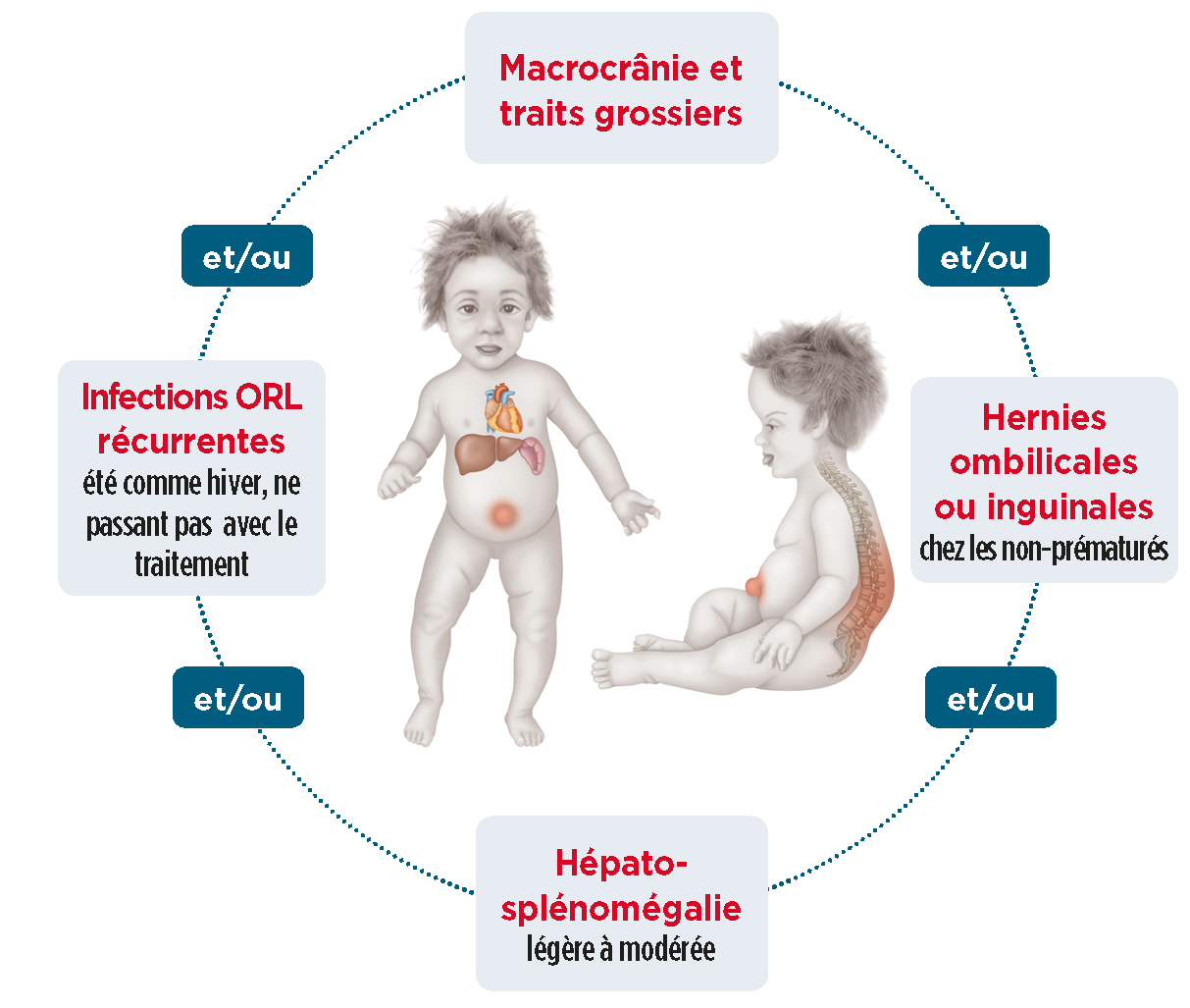 humanoïde bébé de face et de profil avec détail des principaux signes d’appel : dysmorphie / traits grossiers, hépatosplénomé
